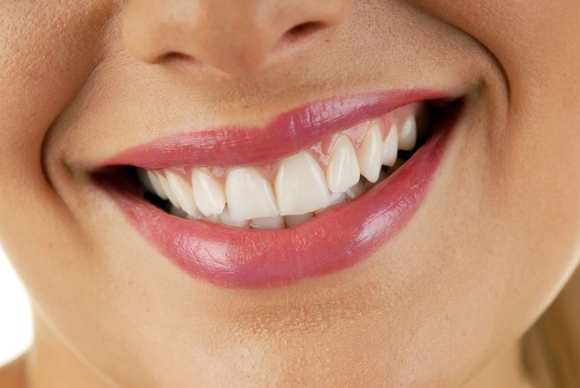 Considerations For Campbelltown Teeth Whitening